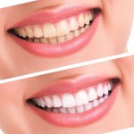 Popular White Teeth Whitening Pen Tooth Gel Whitener Bleach Remove Stains Oral Hygiene