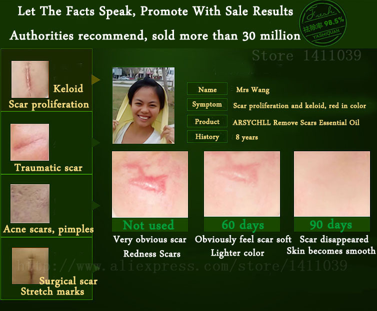 Face-Care-Acne-Scar-Removal-Cream-Acne-Spots-Skin-Care-Treatment-Stretch-Marks-Whitening-Remove-Acne-2030469034