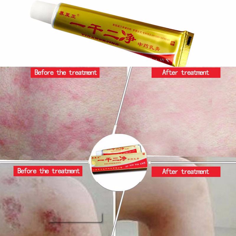 Most-Effective-Cream-For-Eczema-Skin-rash-Psoriasis-Dermatitis-Natural-32711408729