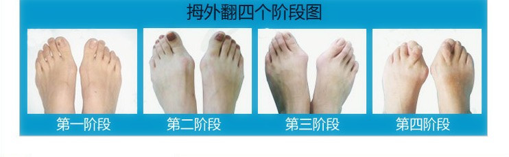 Silicone-Gel-Bunion-Big-Toe-Separator-Spreader-Eases-Foot-Pain-Foot-Hallux-Valgus-Correction-Guard-C-1871460780